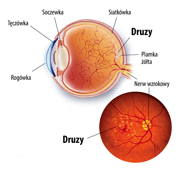 badanie wzroku bydgoszcz