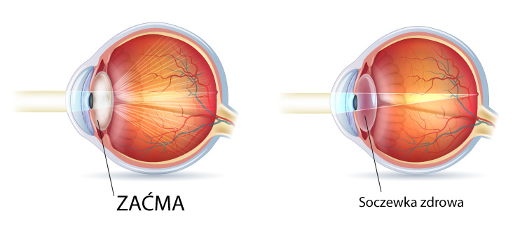 soczewki kontaktowe Bydgoszcz